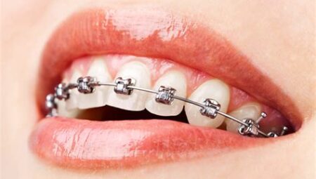 Ortodontik Tedavi Ne Demek