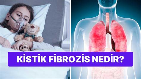 Kistik Fibrozis Nedir? Belirtileri Nelerdir?