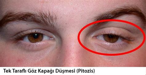 Göz Kapağı Düşmesi (Ptosis) Nedir? Belirtileri ve Tedavisi
